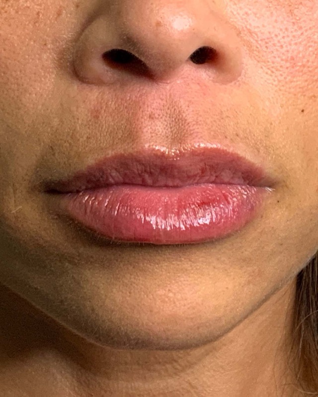 Juvederm Before & After Image