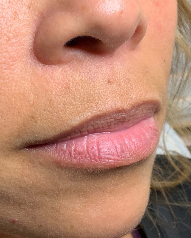 Juvederm Before & After Image