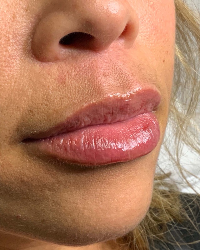 Juvederm Before & After Image