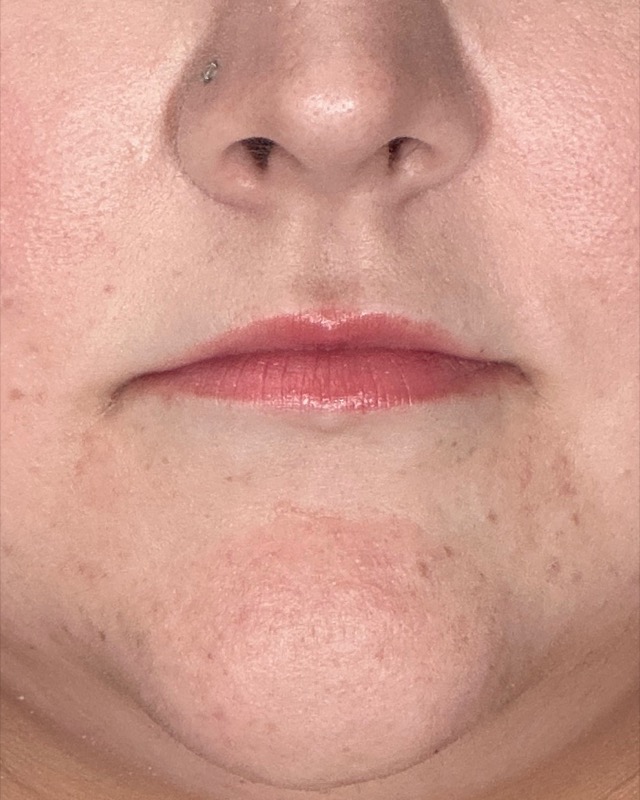 Juvederm Before & After Image