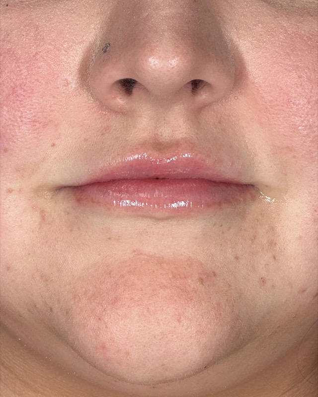 Juvederm Before & After Image