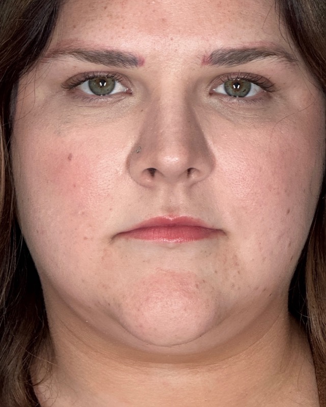 Juvederm Before & After Image