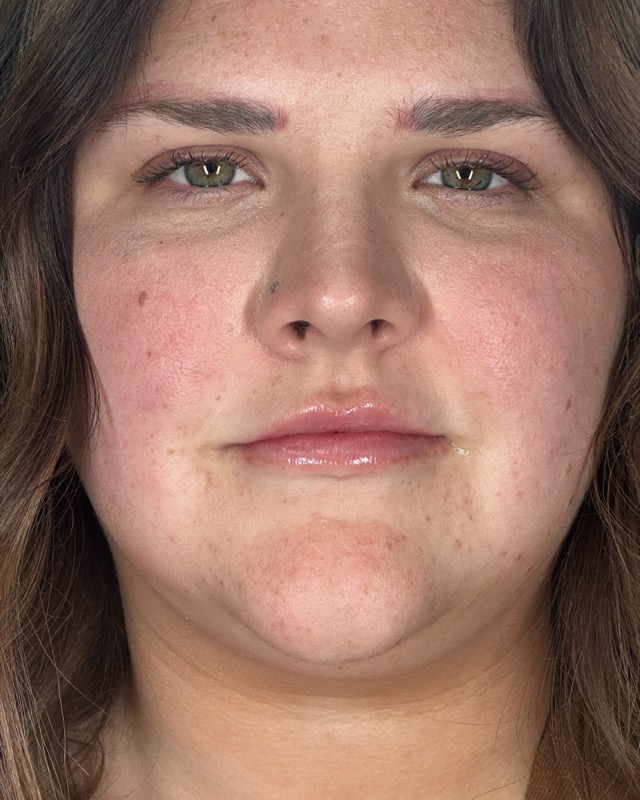 Juvederm Before & After Image