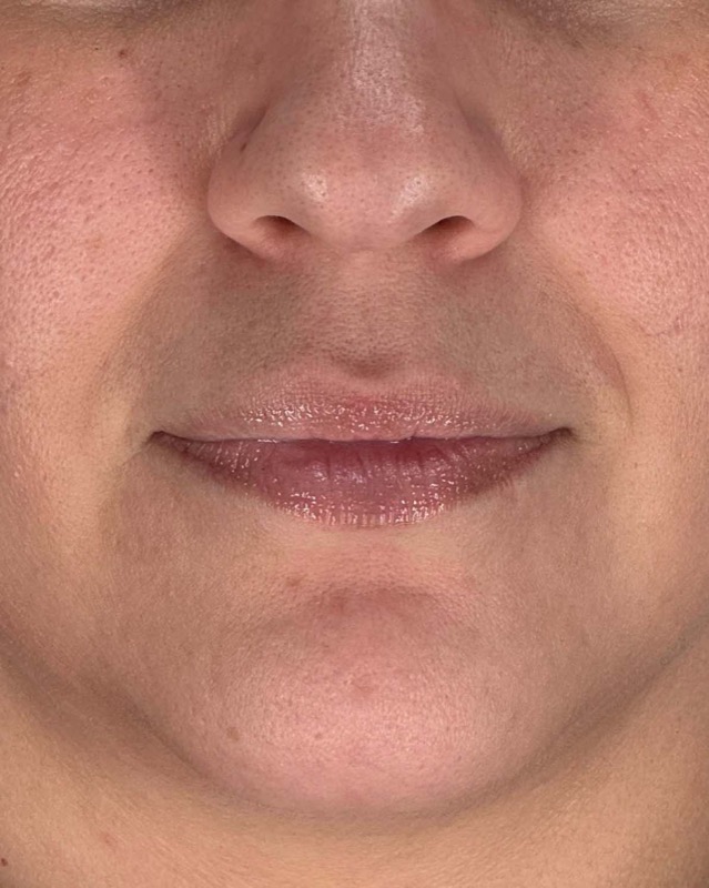 Juvederm Before & After Image