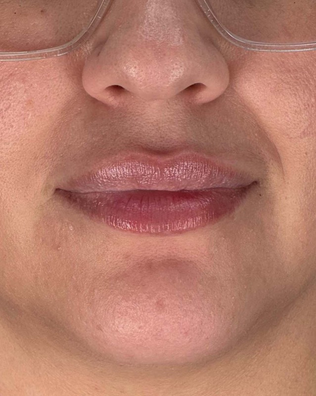 Juvederm Before & After Image