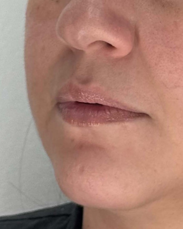 Juvederm Before & After Image