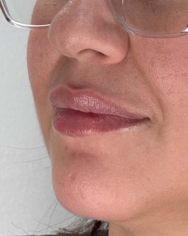 Juvederm Before & After Image