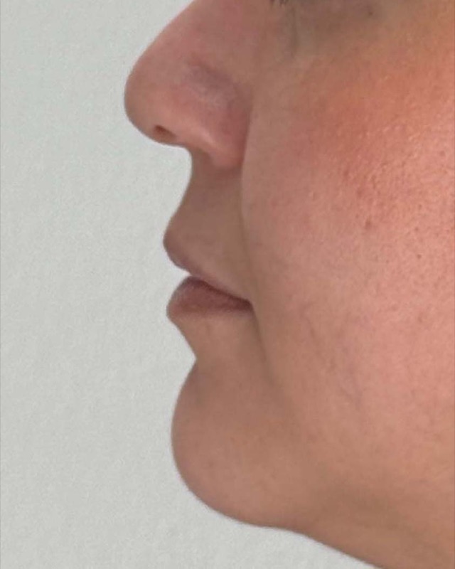 Juvederm Before & After Image