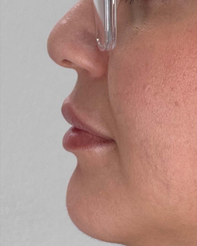 Juvederm Before & After Image