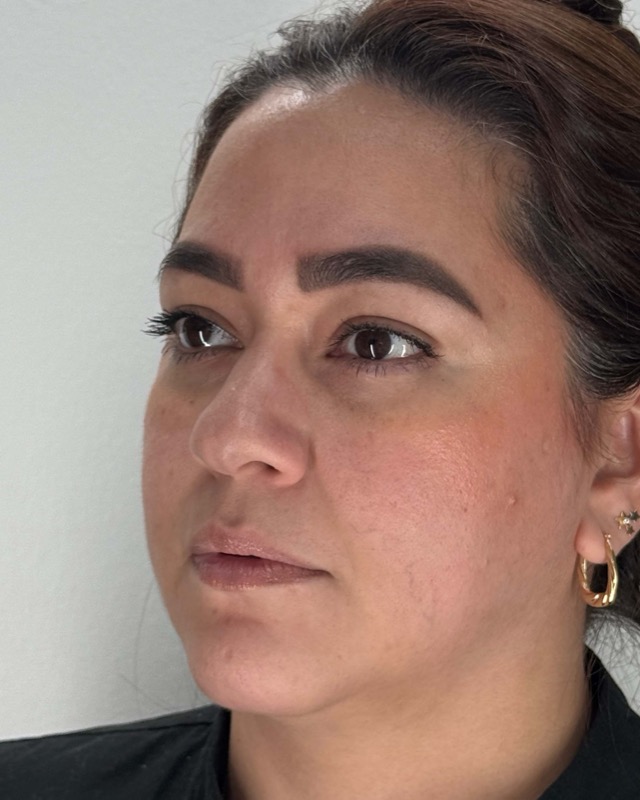 Juvederm Before & After Image