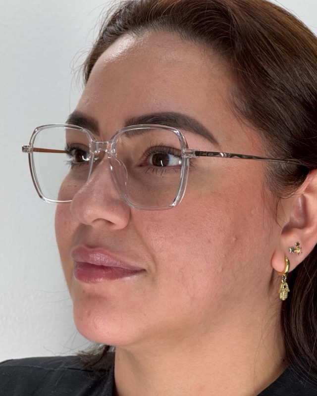 Juvederm Before & After Image