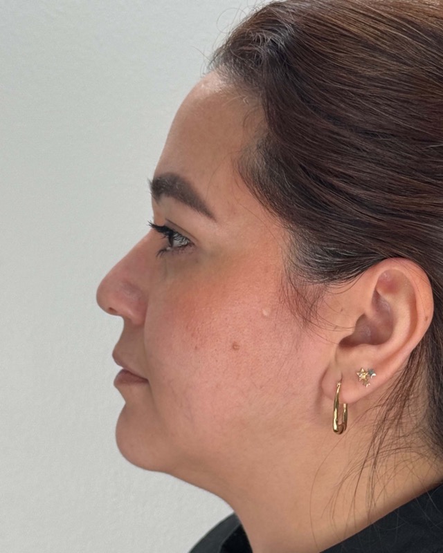 Juvederm Before & After Image