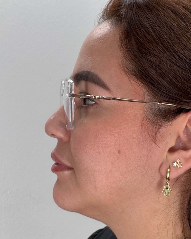 Juvederm Before & After Image