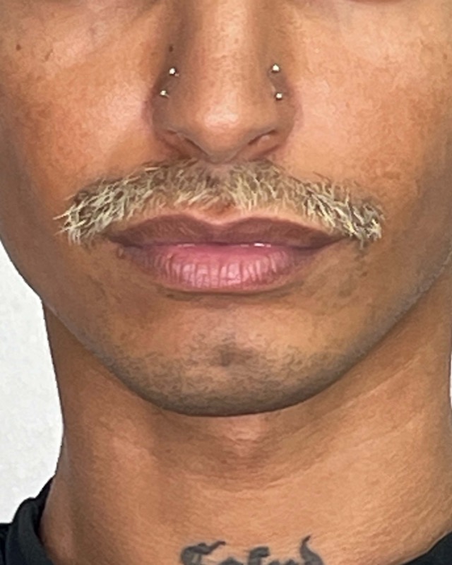 Juvederm Before & After Image