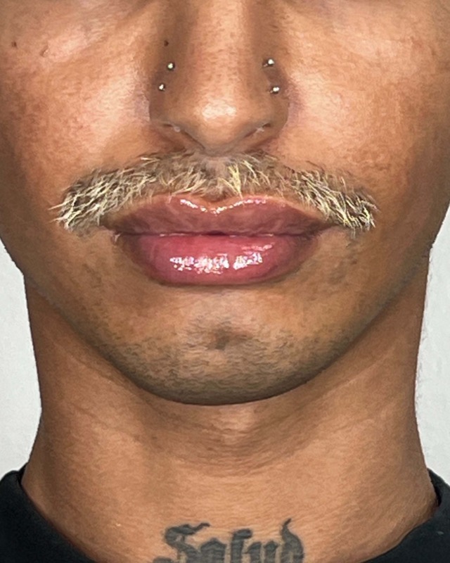 Juvederm Before & After Image