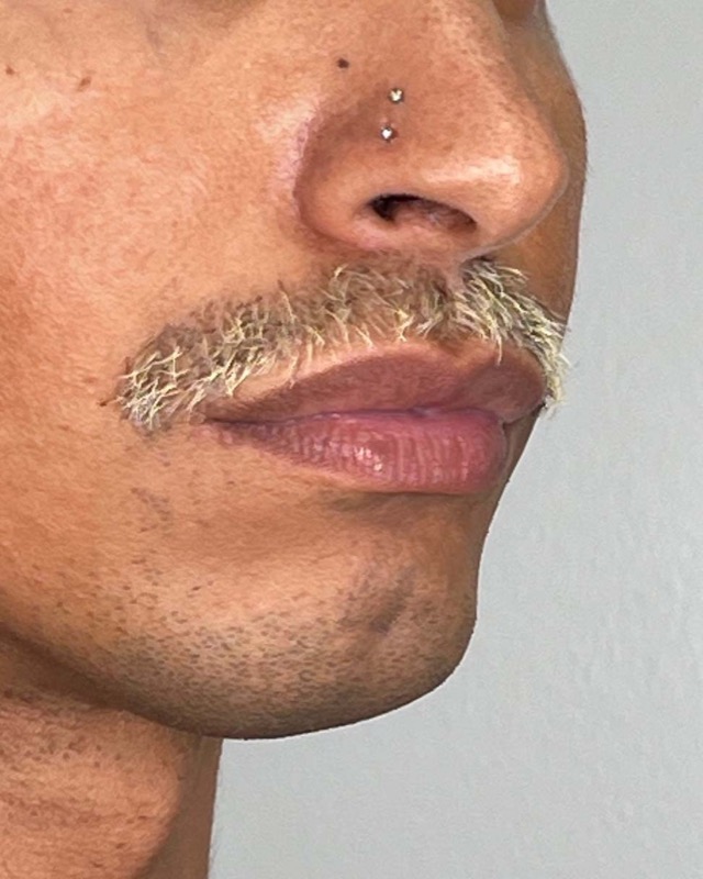 Juvederm Before & After Image