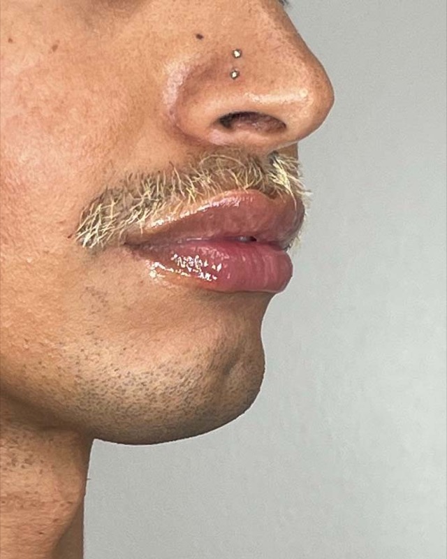 Juvederm Before & After Image