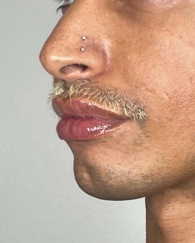 Juvederm Before & After Image