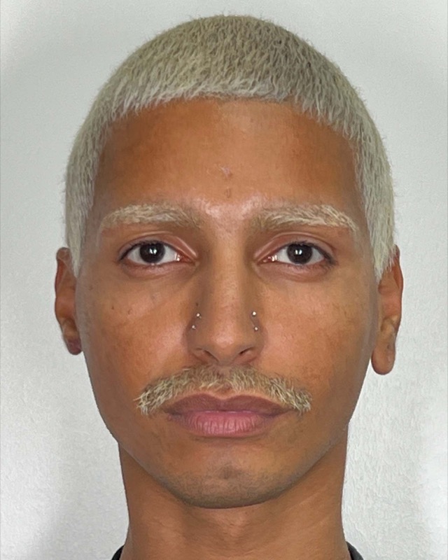 Juvederm Before & After Image