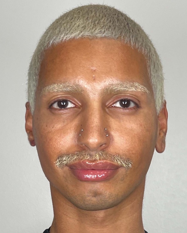 Juvederm Before & After Image