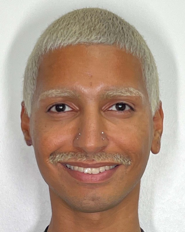 Juvederm Before & After Image