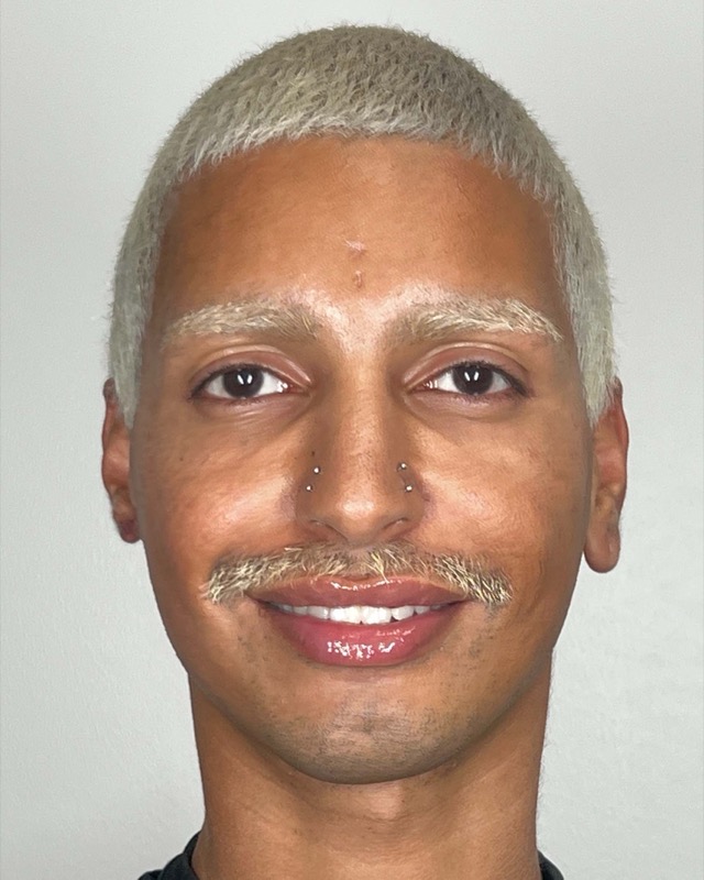 Juvederm Before & After Image