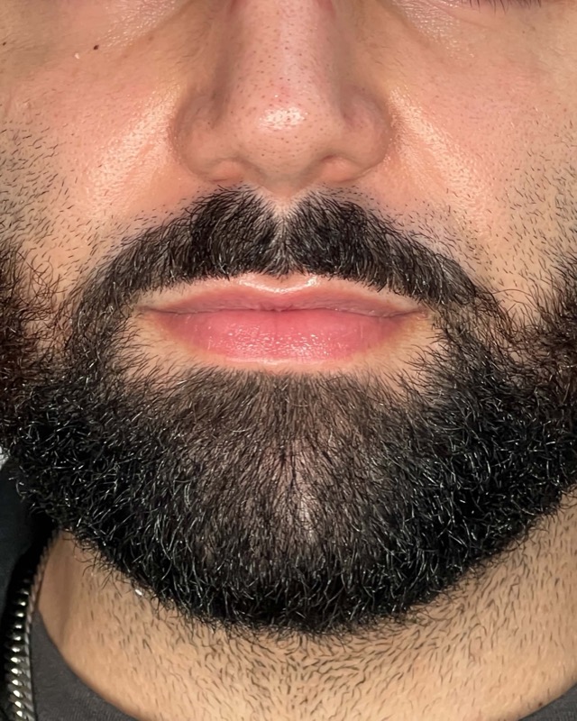 Juvederm Before & After Image