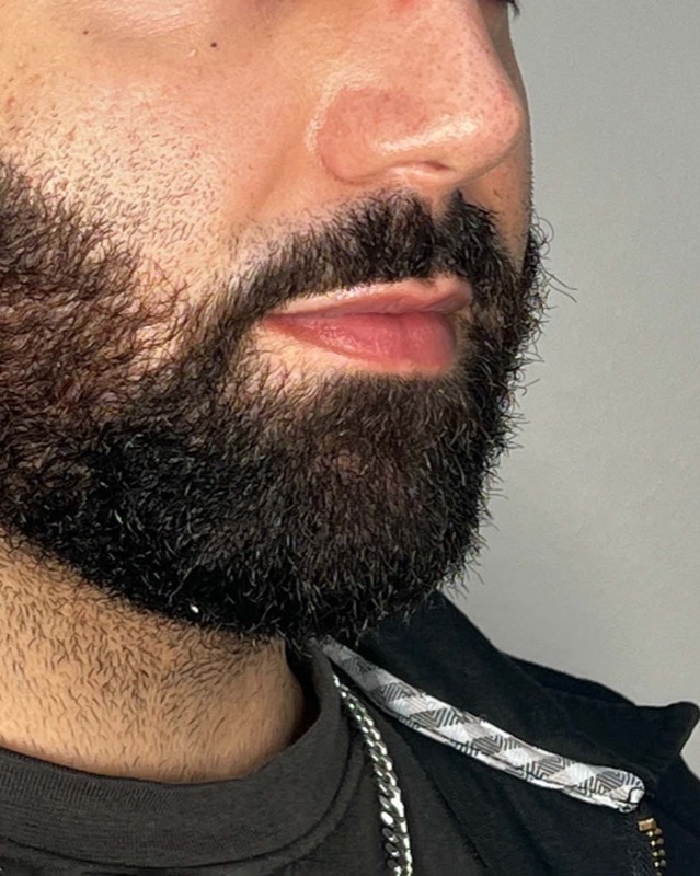 Juvederm Before & After Image