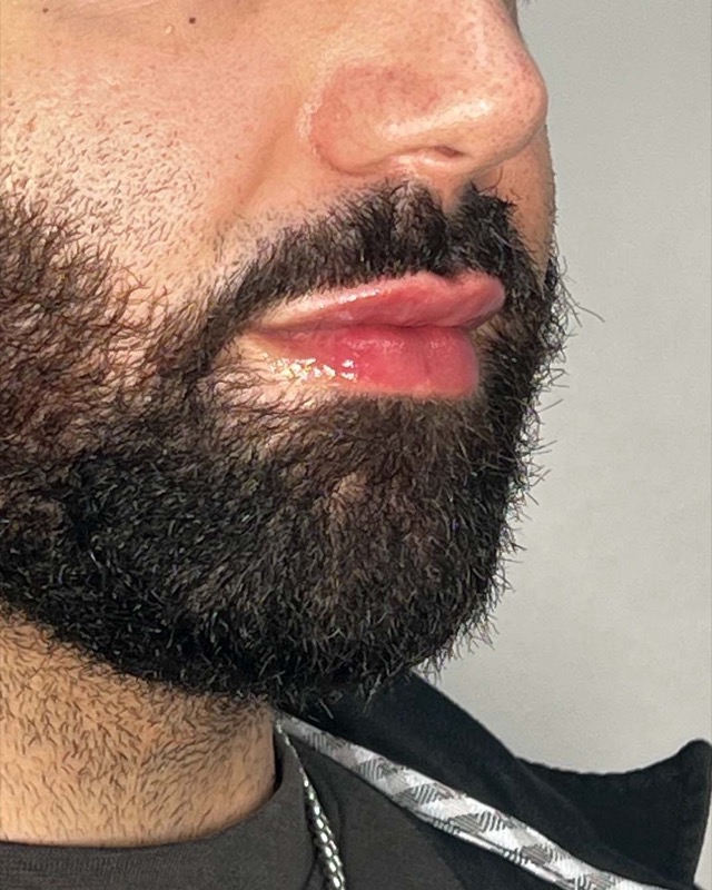 Juvederm Before & After Image