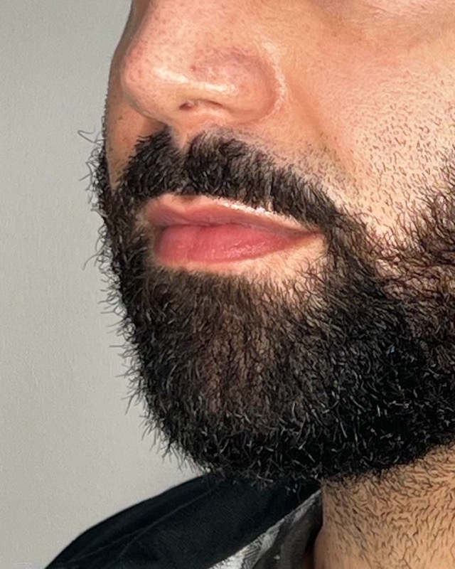 Juvederm Before & After Image