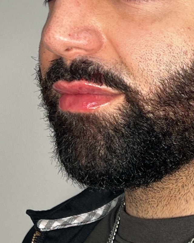 Juvederm Before & After Image