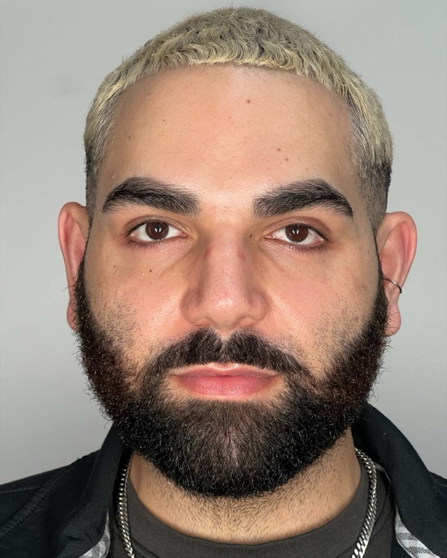 Juvederm Before & After Image