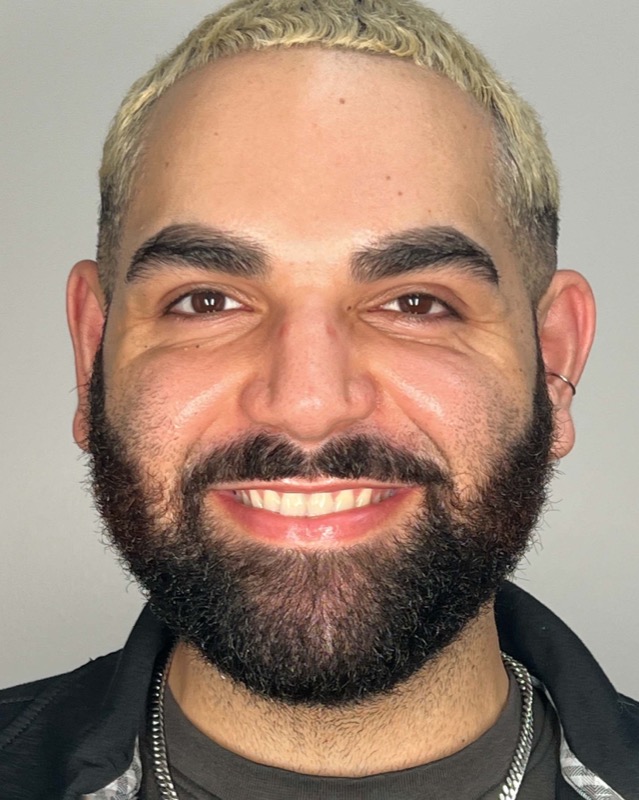 Juvederm Before & After Image