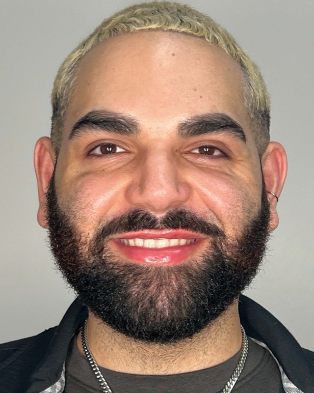 Juvederm Before & After Image