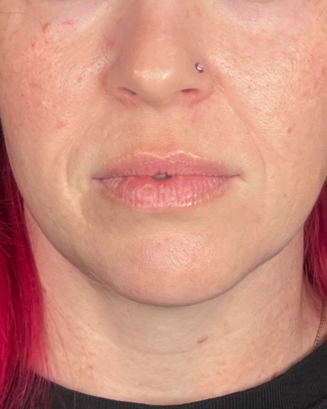 Juvederm Before & After Image