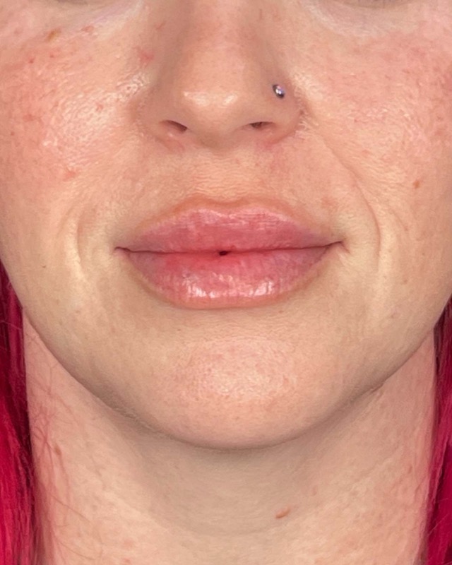 Juvederm Before & After Image
