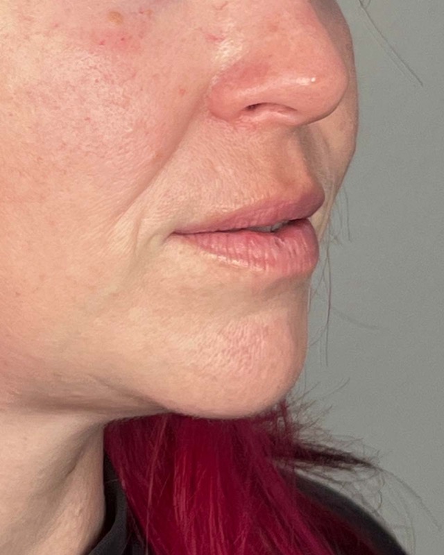 Juvederm Before & After Image