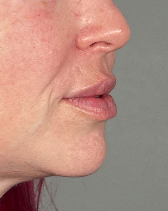Juvederm Before & After Image