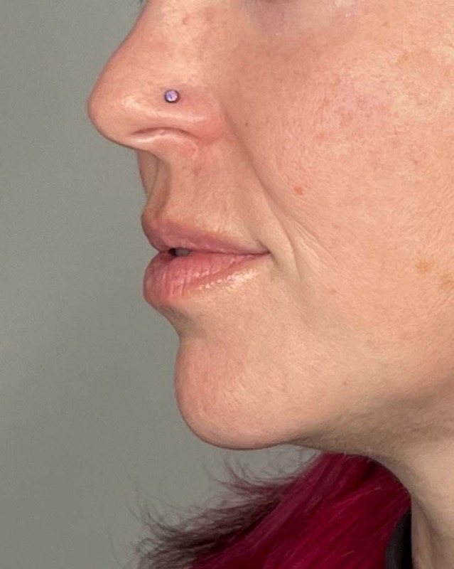 Juvederm Before & After Image