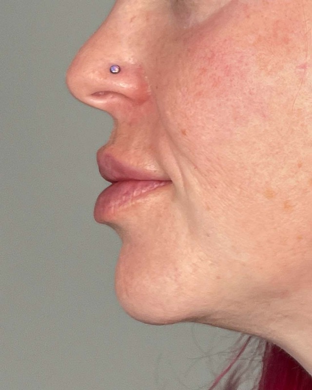 Juvederm Before & After Image