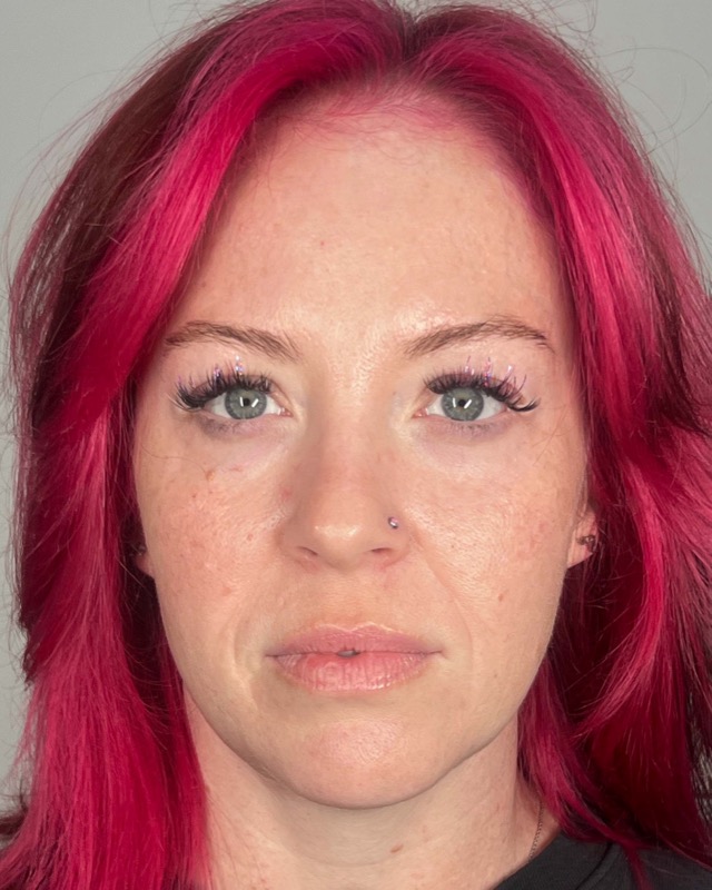 Juvederm Before & After Image