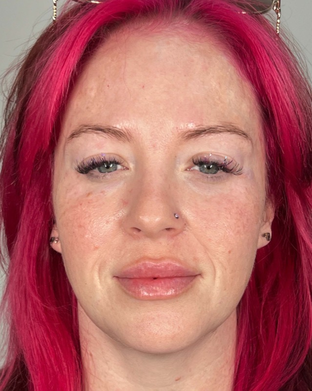 Juvederm Before & After Image