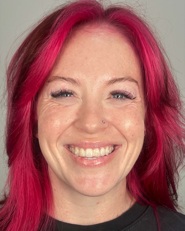 Juvederm Before & After Image