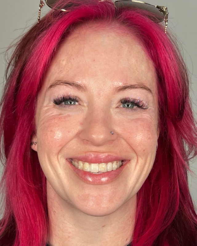 Juvederm Before & After Image