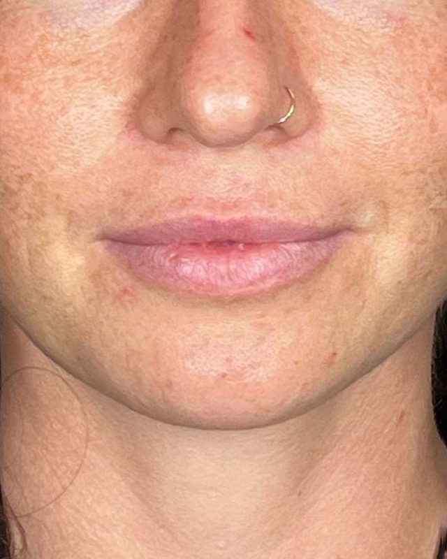 Juvederm Before & After Image