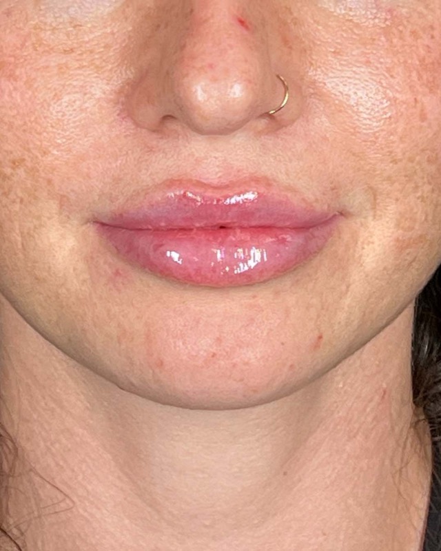 Juvederm Before & After Image