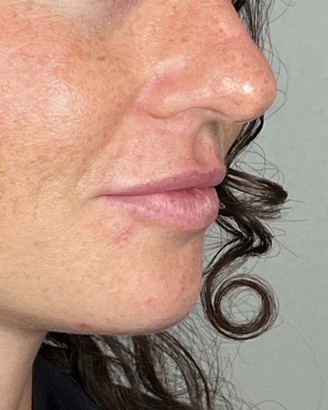 Juvederm Before & After Image