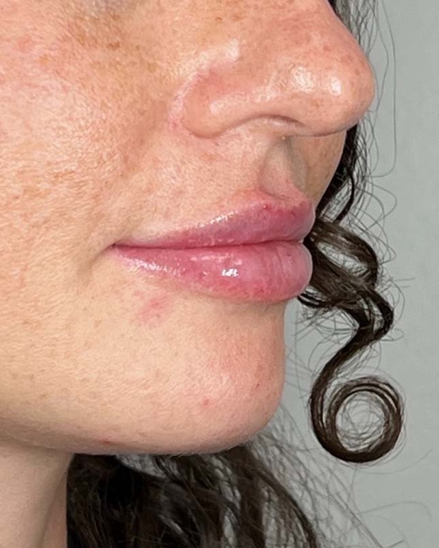 Juvederm Before & After Image