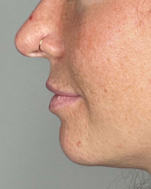 Juvederm Before & After Image