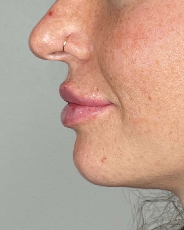 Juvederm Before & After Image